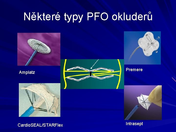 Některé typy PFO okluderů Amplatz Cardio. SEAL/STARFlex Premere Intrasept 