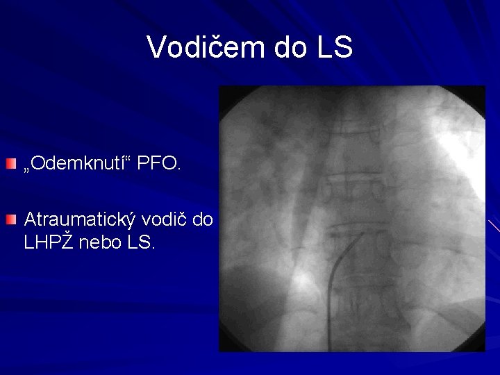 Vodičem do LS „Odemknutí“ PFO. Atraumatický vodič do LHPŽ nebo LS. 