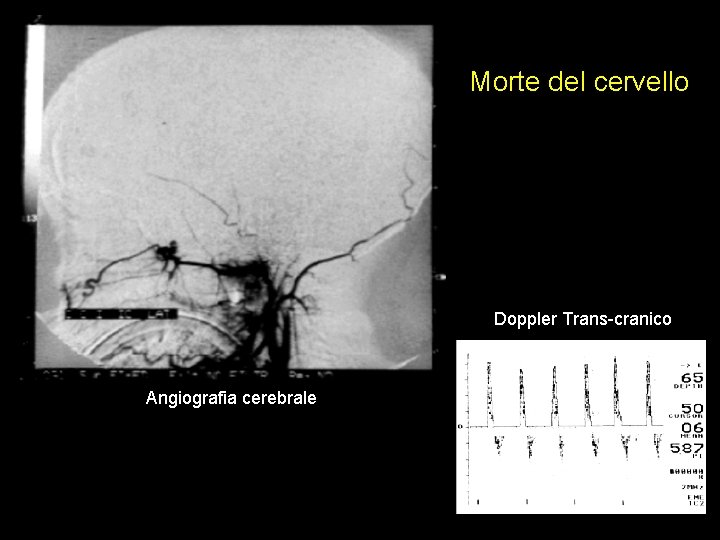 Morte del cervello Doppler Trans-cranico Angiografia cerebrale 