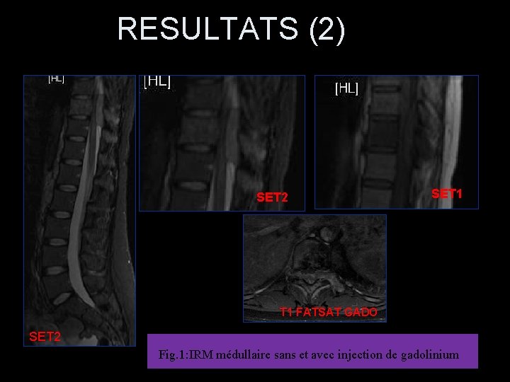 RESULTATS (2) SET 2 SET 1 FATSAT GADO SET 2 Fig. 1: IRM médullaire