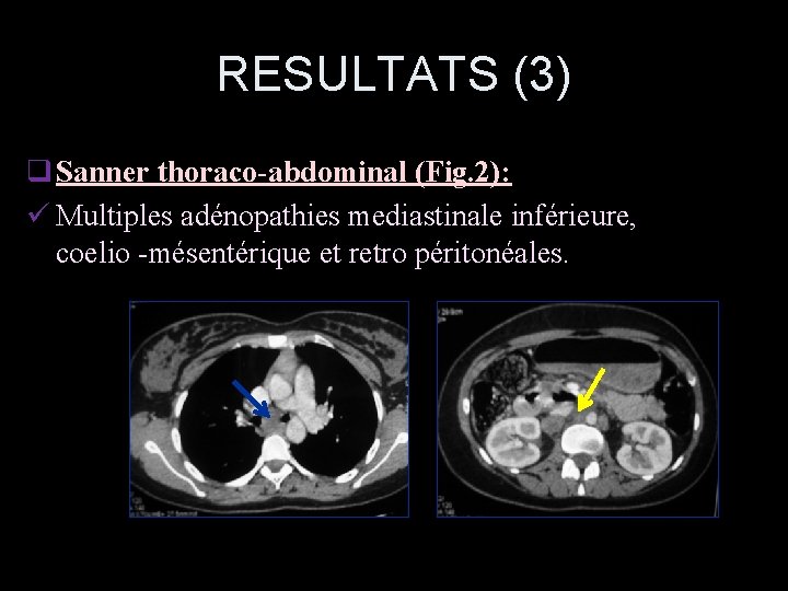 RESULTATS (3) q Sanner thoraco-abdominal (Fig. 2): ü Multiples adénopathies mediastinale inférieure, coelio -mésentérique