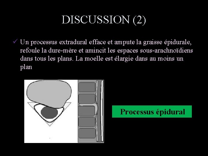 DISCUSSION (2) ü Un processus extradural efface et ampute la graisse épidurale, refoule la