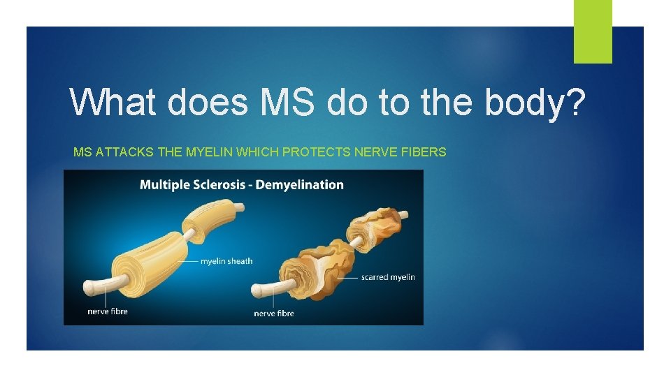 What does MS do to the body? MS ATTACKS THE MYELIN WHICH PROTECTS NERVE