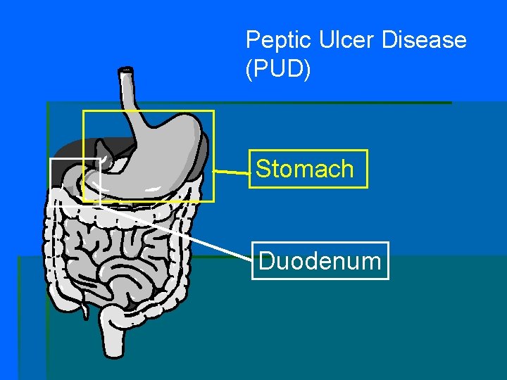 Peptic Ulcer Disease (PUD) Stomach Duodenum 