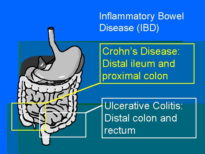 Inflammatory Bowel Disease (IBD) Crohn’s Disease: Distal ileum and proximal colon Ulcerative Colitis: Distal