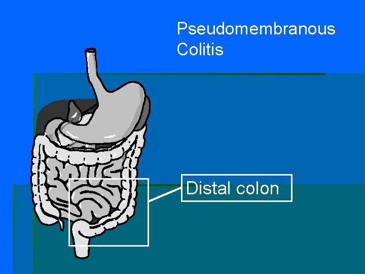 Pseudomembranous Colitis Distal colon 