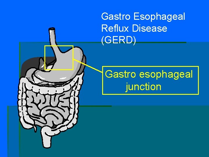 Gastro Esophageal Reflux Disease (GERD) Gastro esophageal junction 