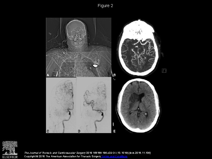Figure 2 The Journal of Thoracic and Cardiovascular Surgery 2019 158186 -196. e 2