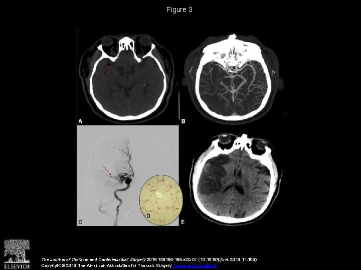 Figure 3 The Journal of Thoracic and Cardiovascular Surgery 2019 158186 -196. e 2