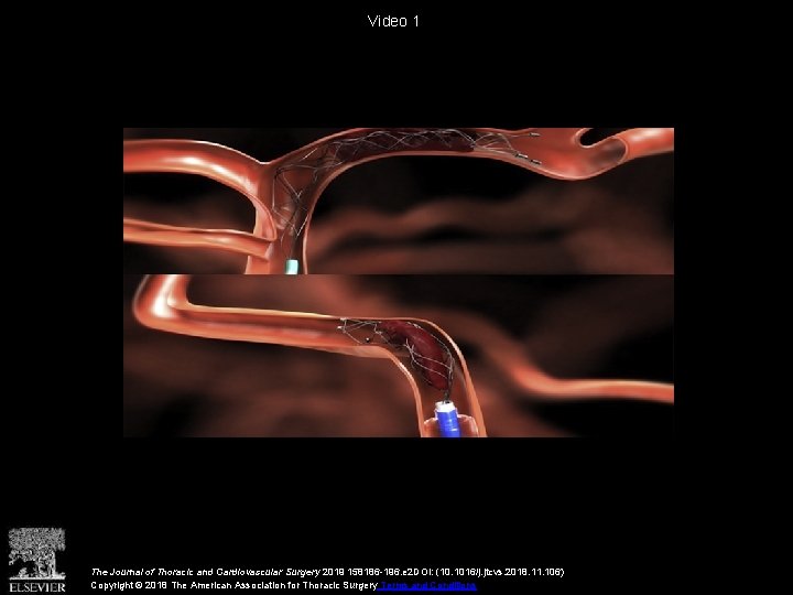 Video 1 The Journal of Thoracic and Cardiovascular Surgery 2019 158186 -196. e 2