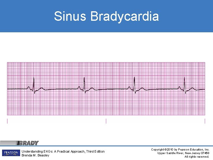 Sinus Bradycardia Understanding EKGs: A Practical Approach, Third Edition Brenda M. Beasley Copyright ©