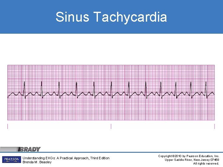 Sinus Tachycardia Understanding EKGs: A Practical Approach, Third Edition Brenda M. Beasley Copyright ©