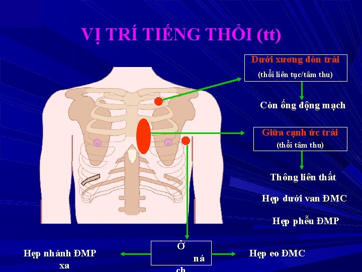 VỊ TRÍ TIẾNG THỔI (tt) Dưới xương đòn trái (thổi liên tục/tâm thu) Còn