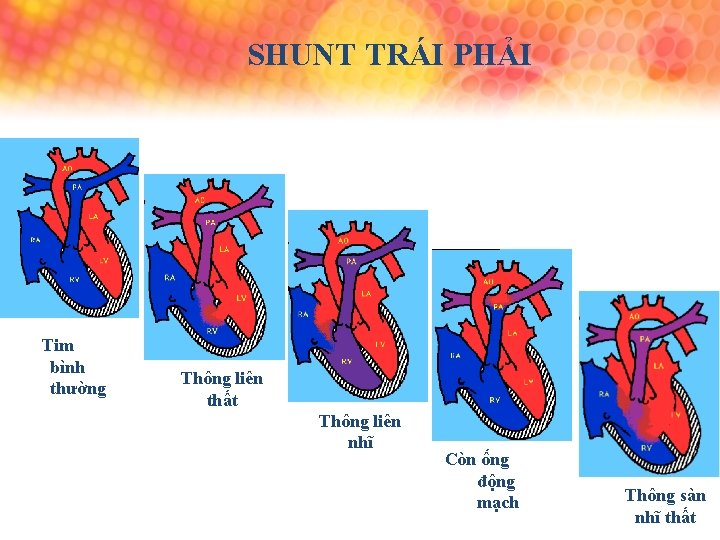 SHUNT TRÁI PHẢI Tim bình thường Thông liên thất Thông liên nhĩ Còn ống