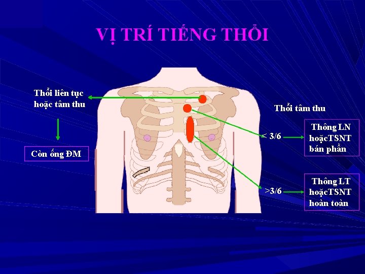 VỊ TRÍ TIẾNG THỔI Thổi liên tục hoặc tâm thu Thổi tâm thu <