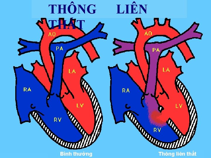 BMBMN -TNB TT BSSS. V T S. VIIỆỆTT THÔNG THẤT Bình thường LIÊN Thông