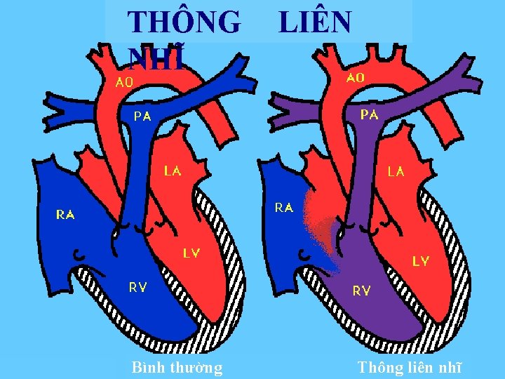 BMBMN -TNB TT BSSS. V T S. VIIỆỆTT THÔNG NHĨ Bình thường LIÊN Thông