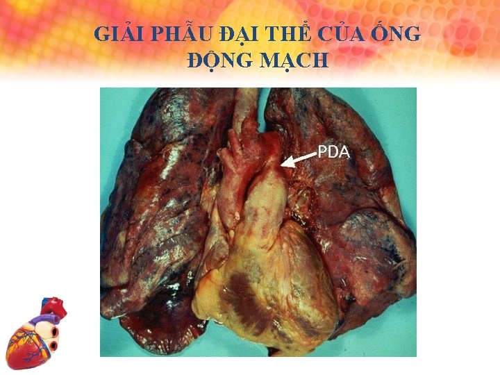 GIẢI PHẪU ĐẠI THỂ CỦA ỐNG ĐỘNG MẠCH 