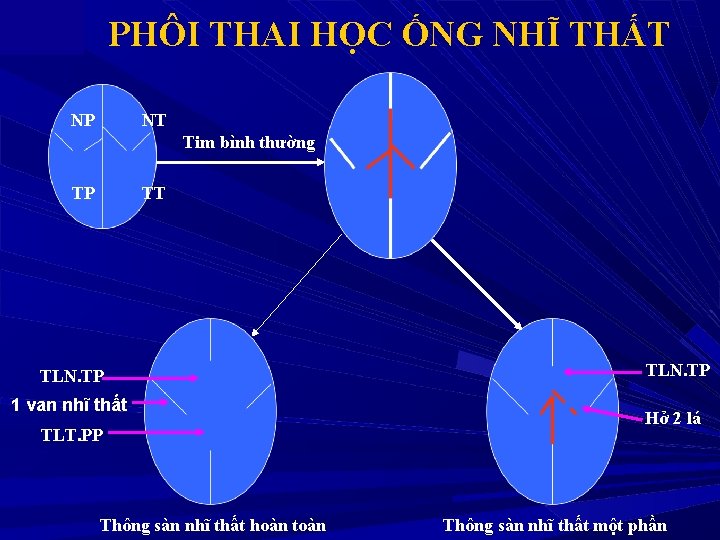 PHÔI THAI HỌC ỐNG NHĨ THẤT NP NT Tim bình thường TP TT TLN.