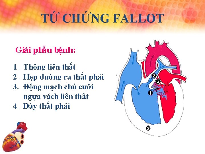 TỨ CHỨNG FALLOT Giải phẫu bệnh: 1. Thông liên thất 2. Hẹp đường ra