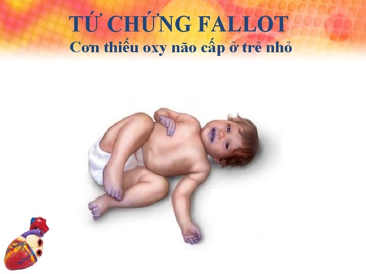 TỨ CHỨNG FALLOT Cơn thiếu oxy não cấp ở trẻ nhỏ 