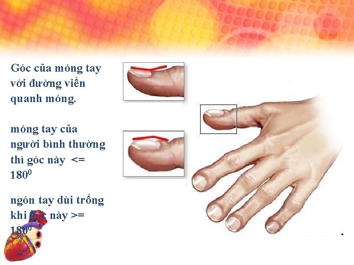 Góc của móng tay với đường viền quanh móng tay của người bình thường