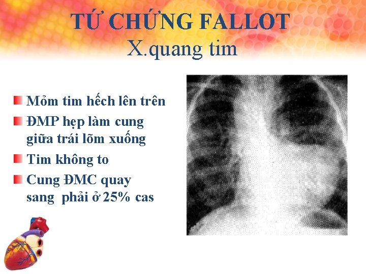 TỨ CHỨNG FALLOT X. quang tim Mỏm tim hếch lên trên ĐMP hẹp làm