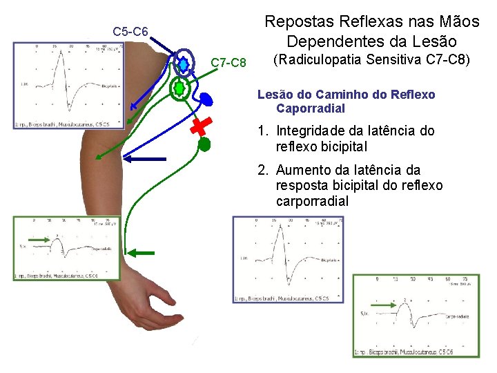 Repostas Reflexas nas Mãos Dependentes da Lesão С 5 -С 6 С 7 -С