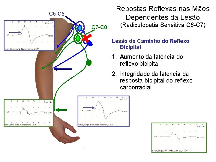 Repostas Reflexas nas Mãos Dependentes da Lesão С 5 -С 6 С 7 -С