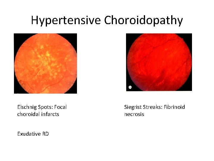 Hypertensive Choroidopathy Elschnig Spots: Focal choroidal infarcts Exudative RD Siegrist Streaks: Fibrinoid necrosis 