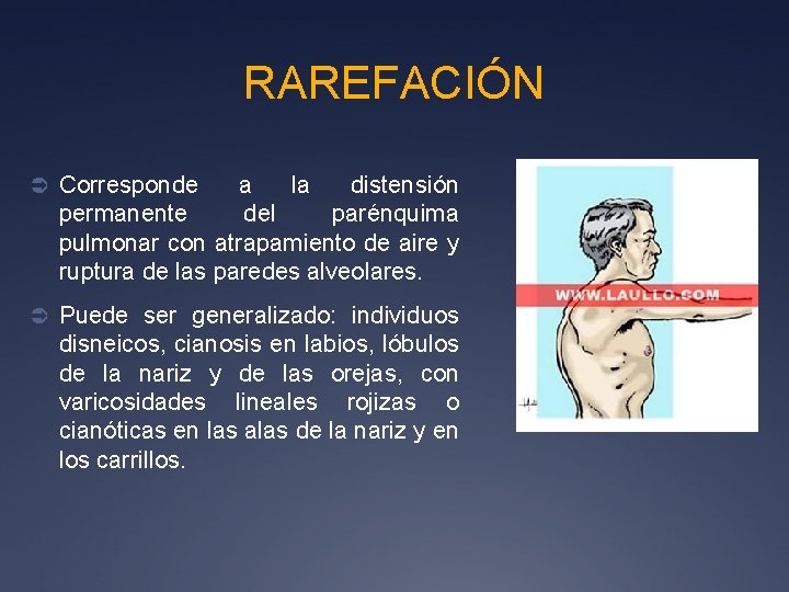 RAREFACIÓN Ü Corresponde a la distensión permanente del parénquima pulmonar con atrapamiento de aire