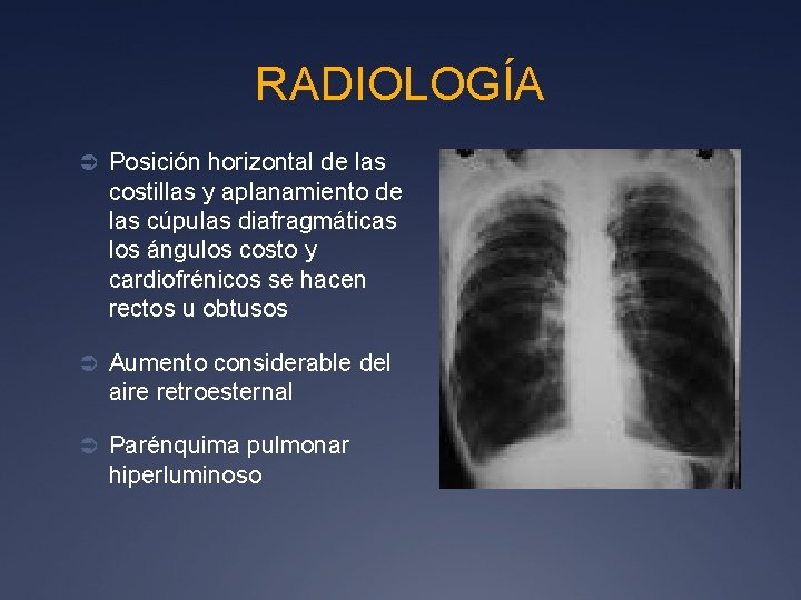 RADIOLOGÍA Ü Posición horizontal de las costillas y aplanamiento de las cúpulas diafragmáticas los