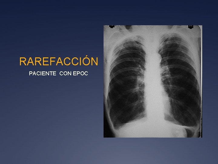 RAREFACCIÓN PACIENTE CON EPOC 