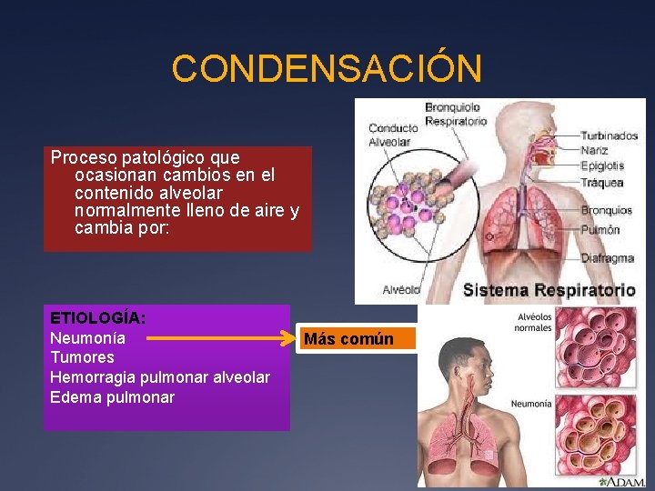 CONDENSACIÓN Proceso patológico que ocasionan cambios en el contenido alveolar normalmente lleno de aire
