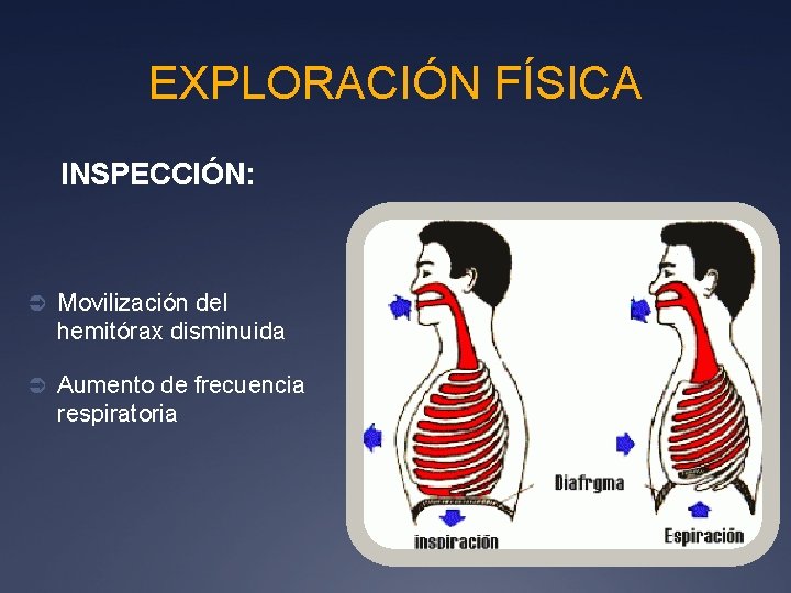 EXPLORACIÓN FÍSICA INSPECCIÓN: Ü Movilización del hemitórax disminuida Ü Aumento de frecuencia respiratoria 