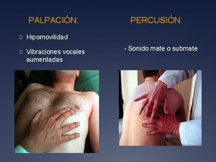 PALPACIÓN: PERCUSIÓN: Ü Hipomovilidad Ü Vibraciones vocales aumentadas • Sonido mate o submate 