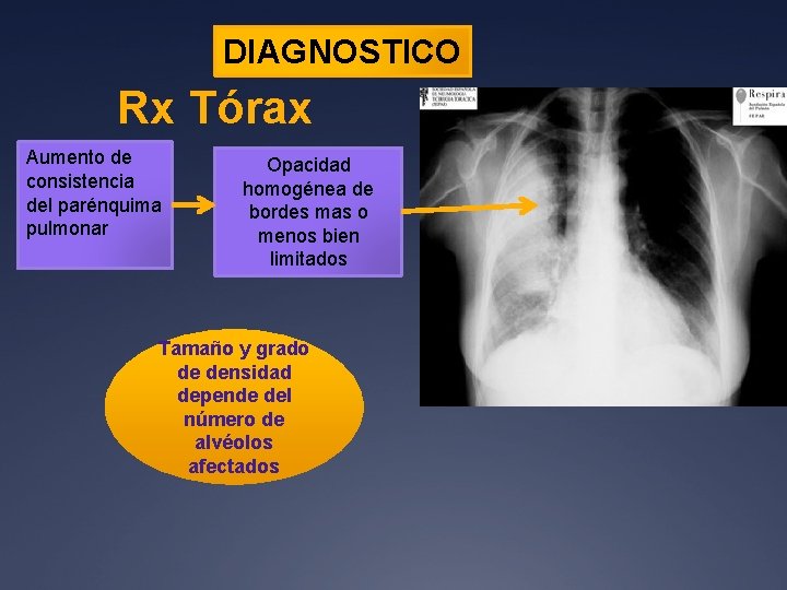 DIAGNOSTICO Rx Tórax Aumento de consistencia del parénquima pulmonar Opacidad homogénea de bordes mas