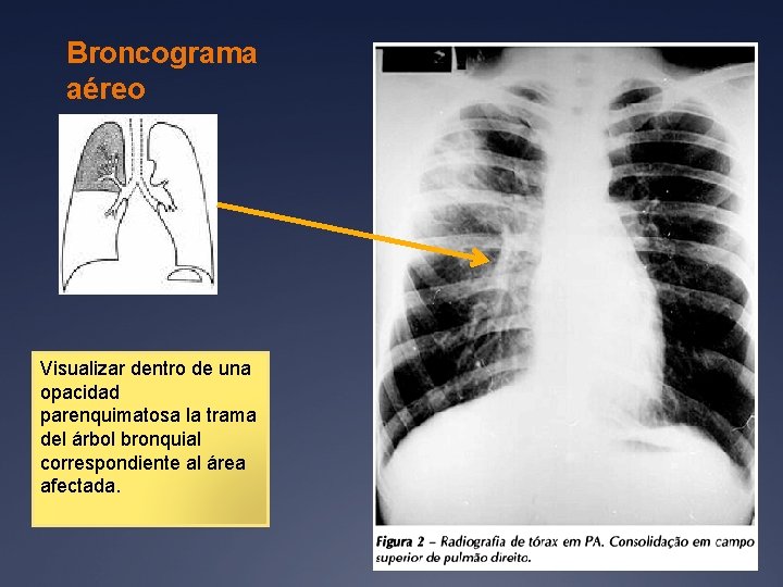 Broncograma aéreo Visualizar dentro de una opacidad parenquimatosa la trama del árbol bronquial correspondiente