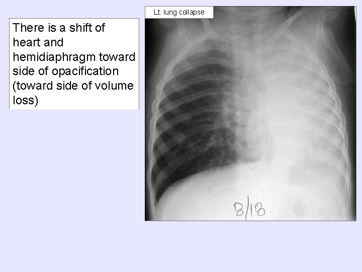 Lt. lung collapse There is a shift of heart and hemidiaphragm toward side of