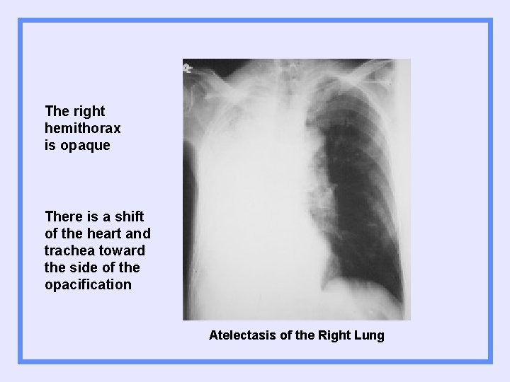 The right hemithorax is opaque There is a shift of the heart and trachea