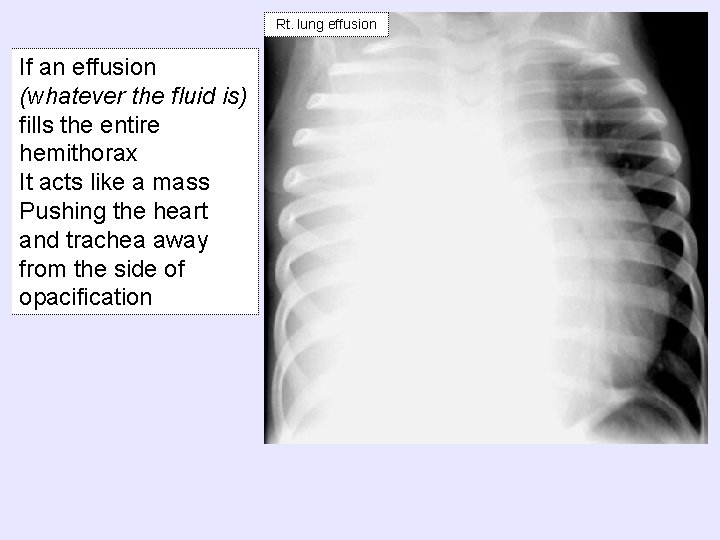 Rt. lung effusion If an effusion (whatever the fluid is) fills the entire hemithorax