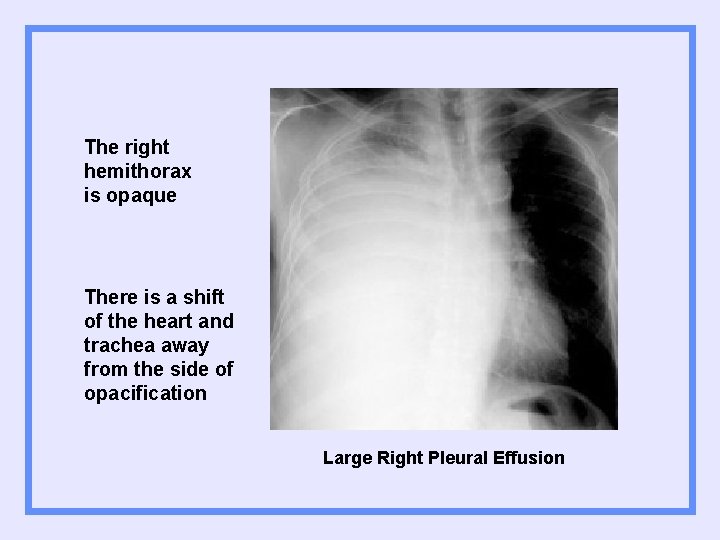 The right hemithorax is opaque There is a shift of the heart and trachea