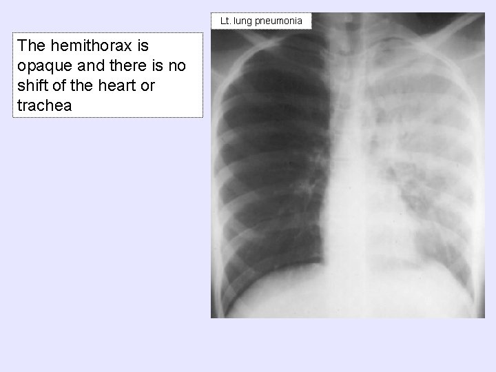 Lt. lung pneumonia The hemithorax is opaque and there is no shift of the
