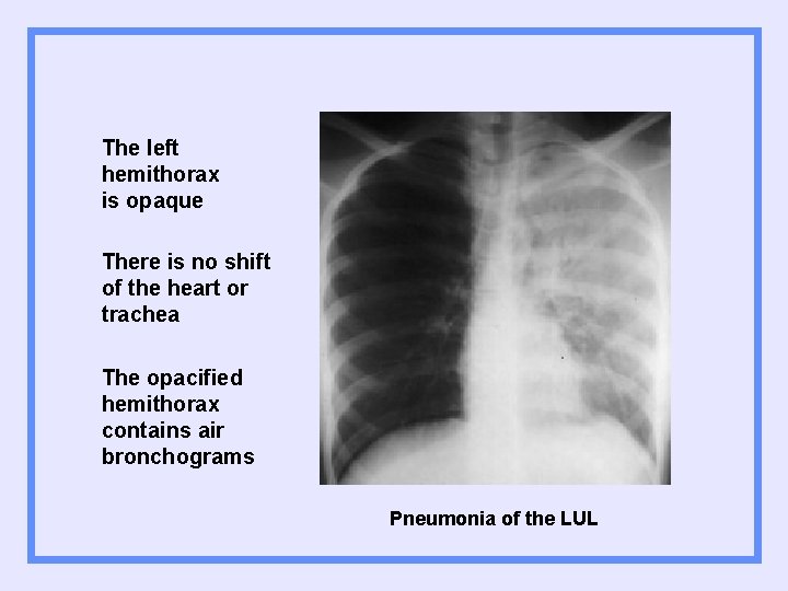 The left hemithorax is opaque There is no shift of the heart or trachea