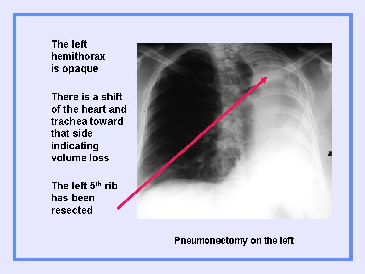 The left hemithorax is opaque There is a shift of the heart and trachea