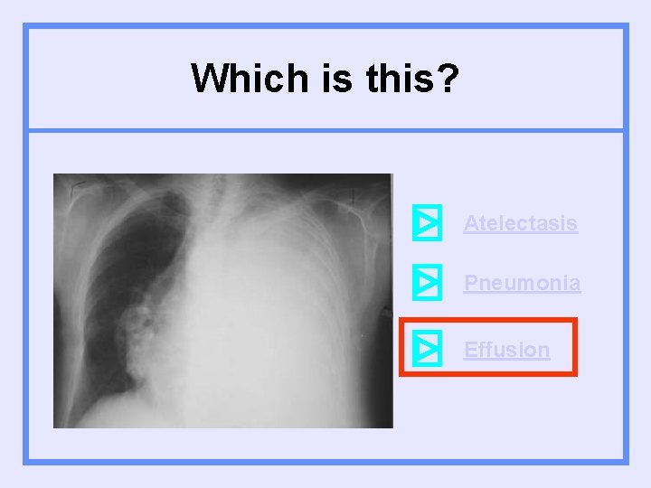 Which is this? Atelectasis Pneumonia Effusion 