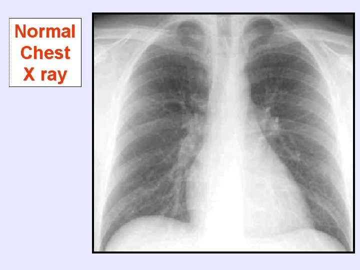 Normal Chest X ray 