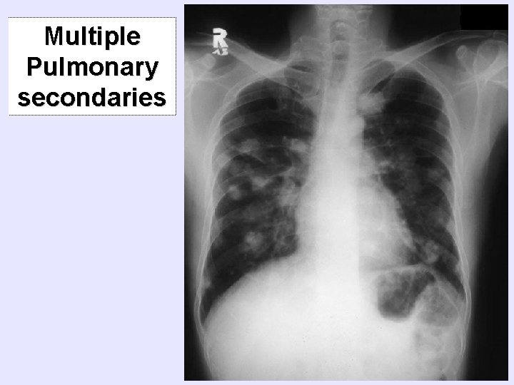 Multiple Pulmonary secondaries 