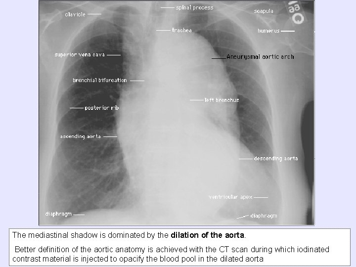 The mediastinal shadow is dominated by the dilation of the aorta. Better definition of