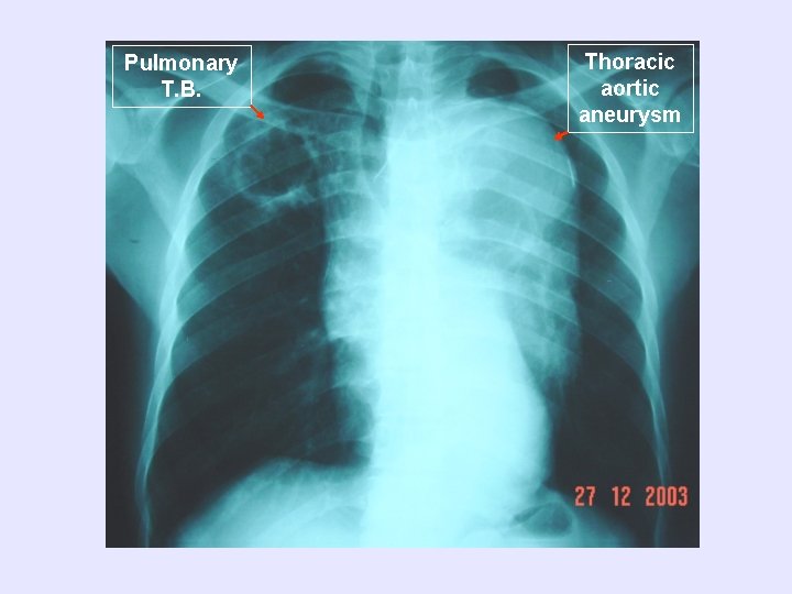 Pulmonary T. B. Thoracic aortic aneurysm 